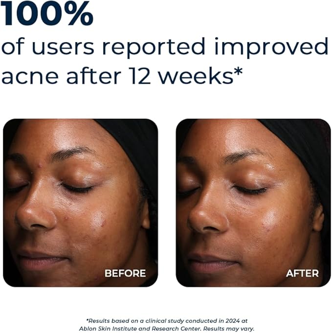 VitaMedica Clear Skin Vitamin Formula | Acne Supplement for Skin Clearing | Breakout Treatment for Women and Men | Vitamins A, C, E, Selenium, Chromium, and Zinc for Acne and Skin Health | 2 Pack