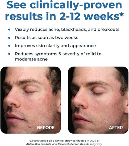 VitaMedica Clear Skin Vitamin Formula | Acne Supplement for Skin Clearing | Breakout Treatment for Women and Men | Vitamins A, C, E, Selenium, Chromium, and Zinc for Acne and Skin Health | 2 Pack